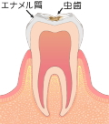 虫歯C1